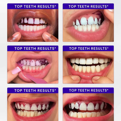 Purple Whitening Strips