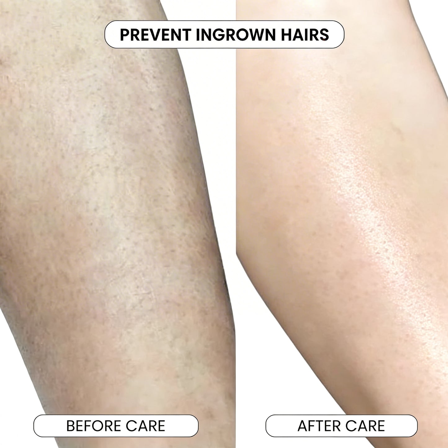 SmoothRoll Ingrown Solution