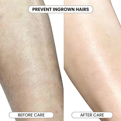 SmoothRoll Ingrown Solution