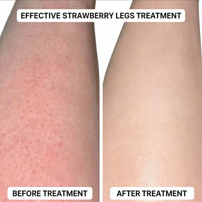 SmoothRoll Ingrown Solution